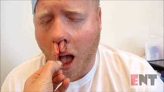 Nasal Packing Removal from The Nose Medical Videos [upl. by Hoopen]