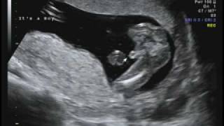 16 weeks Ultrasound  Its a Boy [upl. by Dinnage801]