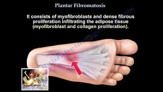 Plantar Fibromatosis  Everything You Need To Know  Dr Nabil Ebraheim [upl. by Theurich]