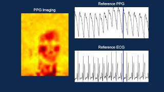 Camera based PPG Imaging [upl. by Heim]