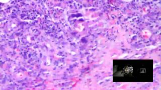 DERMPATH LIVE  January 2016 Clay J Cockerell MD [upl. by Ahsinaj]