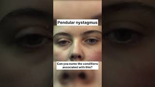 Pendular Nystagmus eyes ophthalmology optometry [upl. by Yee]