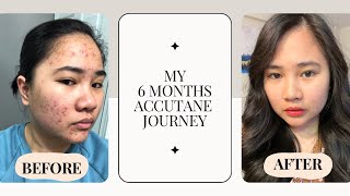 My Accutane Journey [upl. by Alesi]