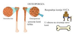 OSTEOPOROZA šta je i kako nastaje [upl. by Laureen]