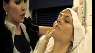 Skin Rejuvenation  Sculptra Treatment live demonstration  female patient [upl. by Schroer]