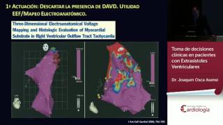 Toma de decisiones clínicas en pacientes con Extrasístoles Ventriculares [upl. by Elohc]