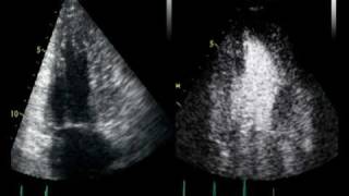 CONTRAST ECHO CARDIOMYOPATHIE TRABECULATION OU NON [upl. by Eitsyrc]