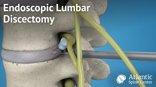 Endoscopic Lumbar Discectomy [upl. by Hershell]