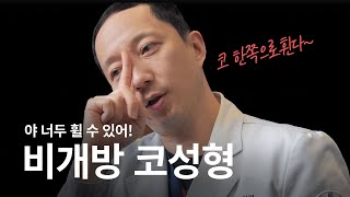 저는 추천하지 않습니다 다만 하실거면 꼭 많이 알아보고 진행하세요 비개방코성형 코수술 코성형 [upl. by Adelpho872]