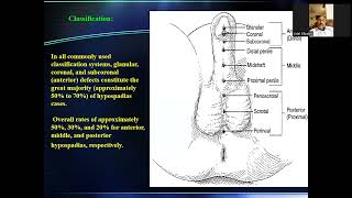 introduction to hypospadias أد عادل البكرى [upl. by Hammad]