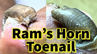 Rams Horn Toenail Severe Fungal Toenail [upl. by Karlene755]