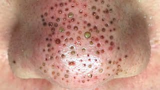 Acne treatment pimples popping blackhead removal on the nose 032 [upl. by Harpp923]