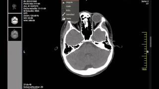 Multiplatform Dicom Viewer [upl. by Holofernes884]