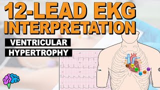 Ventricular Hypertrophy LVH amp RVH on 12Lead EKG [upl. by Blatt]