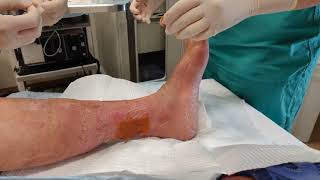 Venous Stasis Ulcer Bandaging and Dressing [upl. by Enyedy]