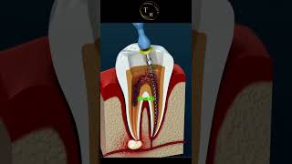 DİŞLERDE Kanal tedavisi science teknoloji bilim [upl. by Enyamrahs]