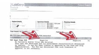 Varicella Zoster Virus Shingles NEGATIVE PCR Test Following Scalar Light Sessions [upl. by Inanak]