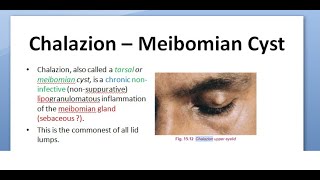 Ophthalmology 376 Chalazion Meibomian Cyst triamcinolone DIATHERMY tetracycline MALIGNANCY Eyelid [upl. by Ettenowtna]