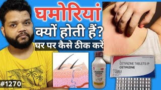 घमोरियां क्यों होती हैं और कैसे ठीक करें  Heat Rash Causes amp Treatment In Hindi [upl. by Karry]