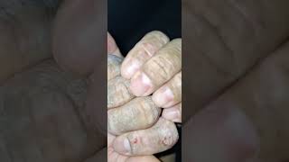 Scratching eczema satisfying eczema asmr scratch [upl. by Yessej109]