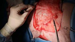 Large soft tissue sarcoma removal from the flank of a dog [upl. by Nlyak]