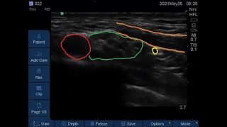 Suprascapular nerve Proximal sonographic anatomy subomohyoid block technique [upl. by Iram]