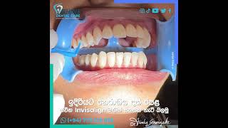 ඉදිරියට නෙරාගිය දත් පෙල නවීන Invisalign මඟින් සකසන හැටි බලමු [upl. by Analra]