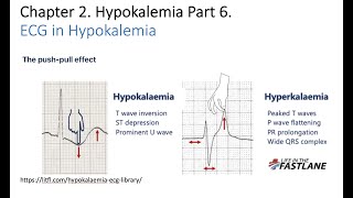 Hypokalemia Part 6 Symptoms Complications and Diagnosis [upl. by Ohcirej]