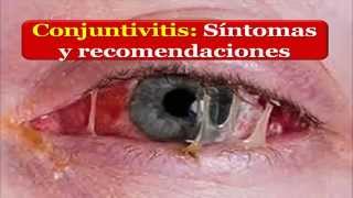 CONJUNTIVTIS Síntomas y recomendaciones en casos de Conjuntivitis [upl. by Ailerua]