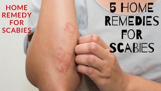 5 Home Remedies for Scabies  home remedy for scabies [upl. by Free]