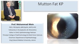 Mutton Fat Keratic Precipitates [upl. by Aleece520]