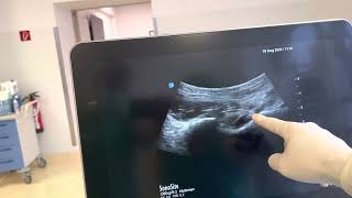 PENG Block pericapsular nerve group ultrasound guided [upl. by Amadis]