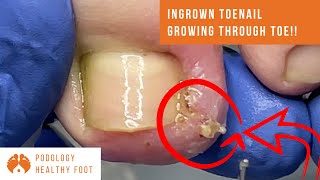 Ingrown toenail GROWING THROUGH TOE in a Relaxing ASMR [upl. by Rosmunda]