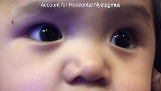 Optic nerve hypoplasia measured by optos  Video abstract ID 242548 [upl. by Ehlke]