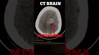 meningioma C T Brain [upl. by Anaicul]