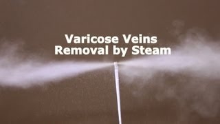 Varicose Vein Removal by Steam Vein Sclerosis from CermaVein [upl. by Eannaj]