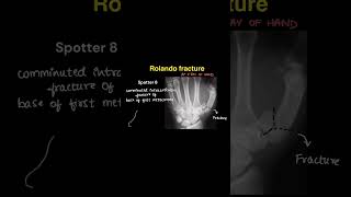 Radiology spotters on our YouTube channel radiologycases spotters neet neetpg pediatrics xray [upl. by Rosenfeld]