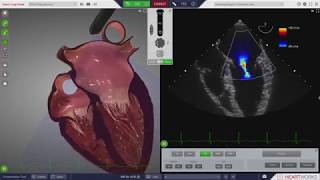 HeartWorks Mitral Regurgitation [upl. by Nivi]