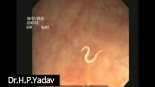 Live Pinworm Seen On Colonoscopy [upl. by Enoob]