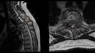 Spinal epidural abscess  spondylodiscitis  insufficiency spinal fracture CT and MRI correlation [upl. by Nnylorac922]