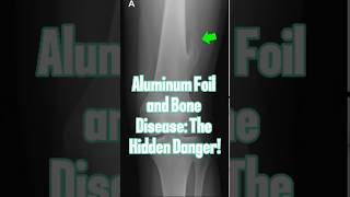 Aluminum Foil and Bone Disease The Hidden Danger [upl. by Valencia631]