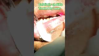 Exfoliatve cheilitis treated by Laser [upl. by Naujuj]