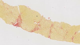 HISTALIM Chronic diseases  Hepatic fibrosis collagen quantification on human liver [upl. by Scarrow42]