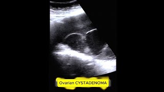 OVARIAN CYST ADENOMA mass infertility ovarian [upl. by Llevel427]