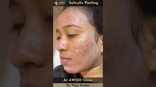 Peeling Treatment  Salicylic peel for pigmentation and acne peeling shorts awishclinic [upl. by Ennaear]