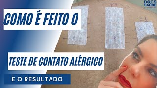 Como é feito o teste de contato alérgico [upl. by Letta]