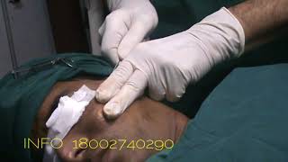 ACNE SCARS SUBCISION amp FAT GRAFTINGPUNE [upl. by Ruyle]