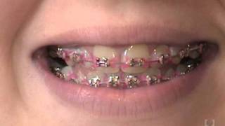 Orthodontic Care Videos  Disclosing Tablets [upl. by Akkahs]