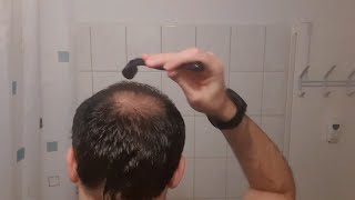 Minoxidil  Derma Roller Results I 4 Months Update [upl. by Chadd]