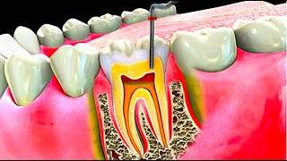 What is a Root Canal Root Canal Procedure Step by Step [upl. by Neelcaj]